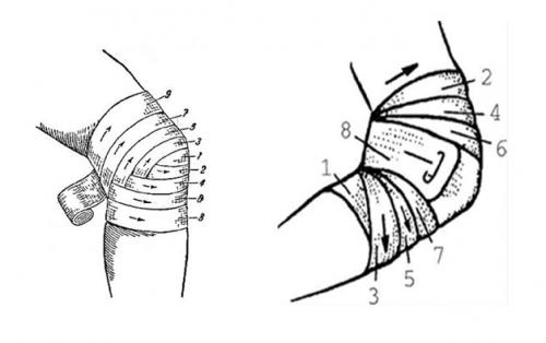 Черепашья повязка на локтевой сустав