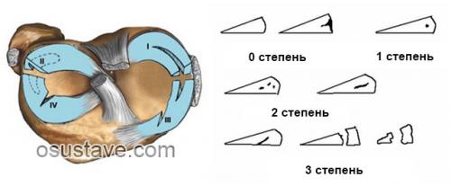 Разрыв заднего рога медиального мениска 3б степени. Виды повреждений мениска коленного сустава: их обзор, степени, симптомы и лечение