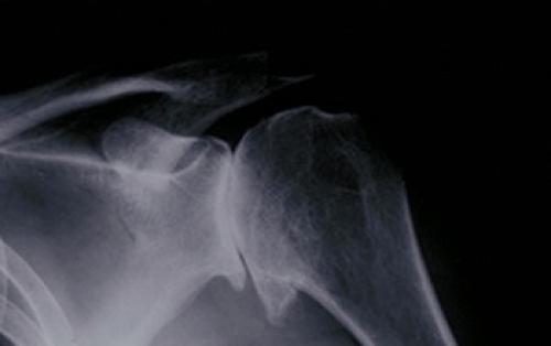 Хрустят плечевые суставы, что делать. От чего появляется? 06 Хрустят плечевые суставы, что делать. От чего появляется? 06