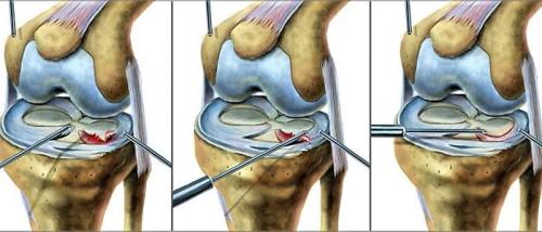 Повреждение мениска 3б степени по stoller. Степени повреждения мениска