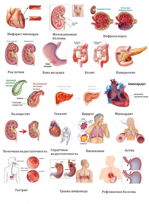 Сводит мышцы под ребрами. Почему возникают мышечные спазмы в ребрах и как их устранить?