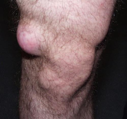 На коленном суставе шишка сбоку, что это может быть. Что это?