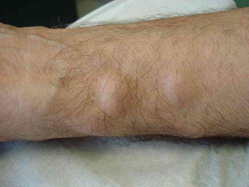 Шишки на пальцах рук чешутся. Основные признаки и различия