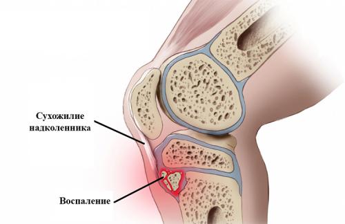 На коленном суставе шишка сбоку, что это может быть. Что это?