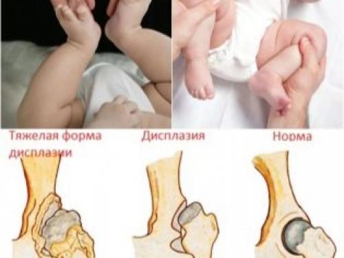 Рентген дисплазия тазобедренного сустава. Рентген тазобедренного сустава в детском возрасте 01 Рентген дисплазия тазобедренного сустава. Рентген тазобедренного сустава в детском возрасте 01