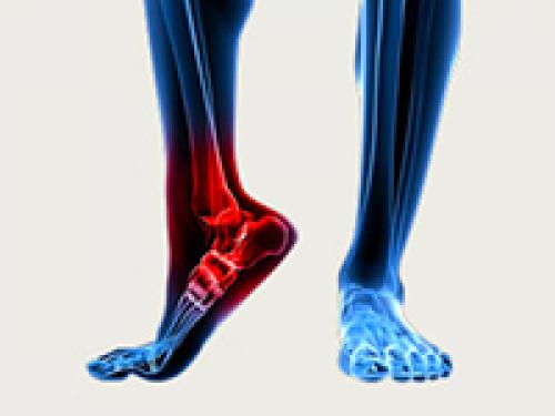 Артроз 2 3 степени. Причины артроза 03