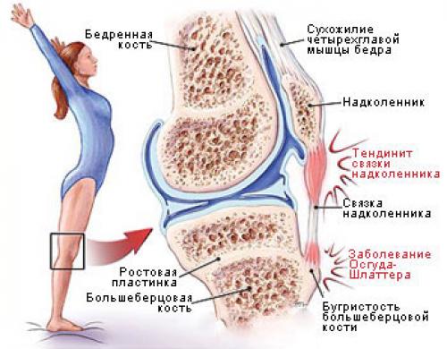 Тендинит лечение. Как лечить тендинит коленного сустава?