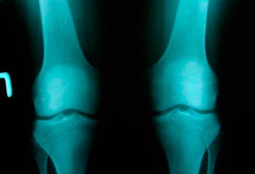 Гонартроз 2 степени инвалидность. Степени гонартроза