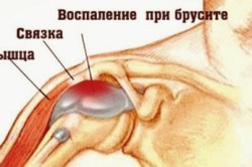 Хруст в лопатке. Причины возникновения заболевания