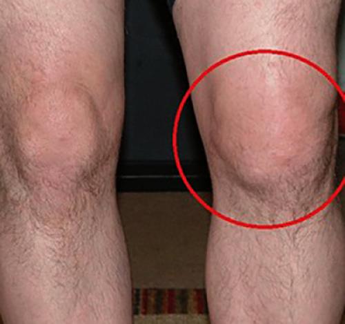 На коленном суставе шишка сбоку, что это может быть. Что это?