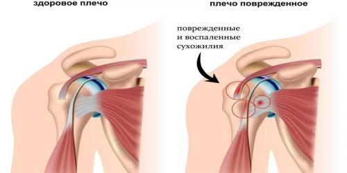 Бурсит плечевого сустава симптомы и лечение. Бурсит плечевого сустава — симптомы и лечение в домашних условиях с видео