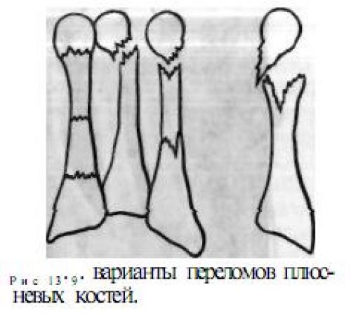 Неправильные кости. Перелом головки плюсневой кости кисти. Плюсневая кость маршевый перелом. Перелом Джонса 5 плюсневой кости. Неправильно сросшийся перелом 5 плюсневой кости.