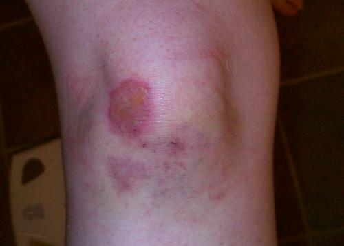 На коленном суставе шишка сбоку, что это может быть. Что это?