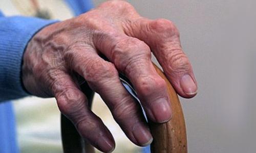 На суставе шишка. Шишки на суставах пальцев рук: причины, симптомы и лечение 10