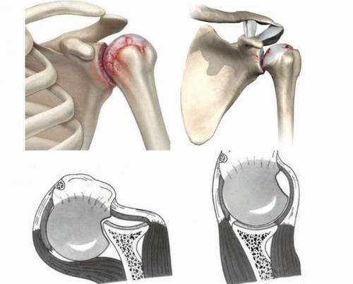 Повреждения хилла Сакса. Повреждение Хилл Сакса плеча 03 Повреждения хилла Сакса. Повреждение Хилл Сакса плеча 03