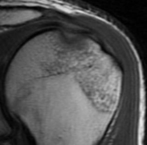 Повреждения хилла Сакса. Повреждение Хилл Сакса плеча 05 Повреждения хилла Сакса. Повреждение Хилл Сакса плеча 05