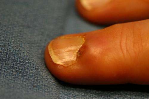 Растет косточка на пальце руки к какому врачу. Шишка на руках