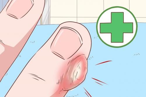 Растет косточка на пальце руки к какому врачу. Шишка на руках