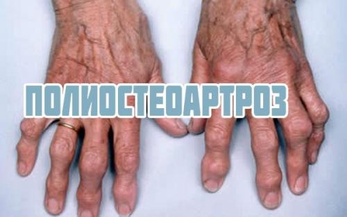 Как снять воспаление сустава пальца. Причины боли в суставах пальцев