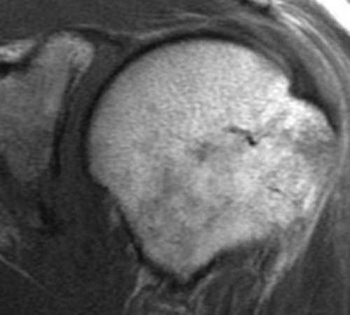 Повреждения хилла Сакса. Повреждение Хилл Сакса плеча 06 Повреждения хилла Сакса. Повреждение Хилл Сакса плеча 06