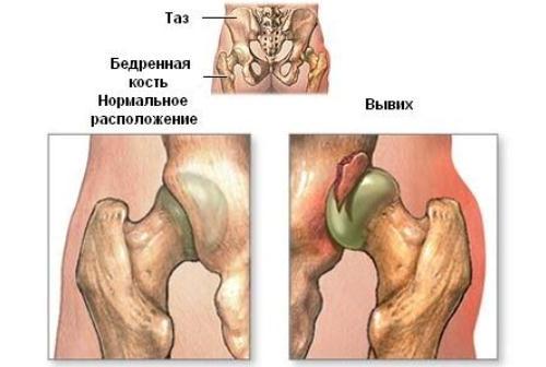 Ограничения после эндопротезирования тазобедренного сустава. Разрешено в этот период