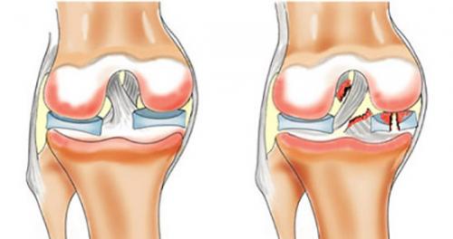 Сколько заживает разрыв связок колена. Сколько в среднем заживает разрыв связок коленного сустава