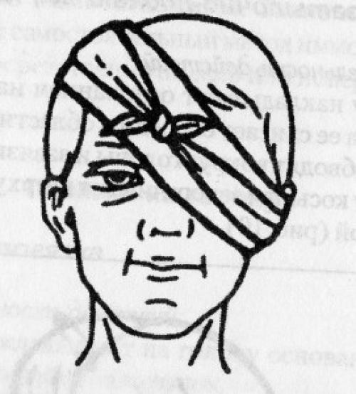 Пращевидная. Косыночные повязки