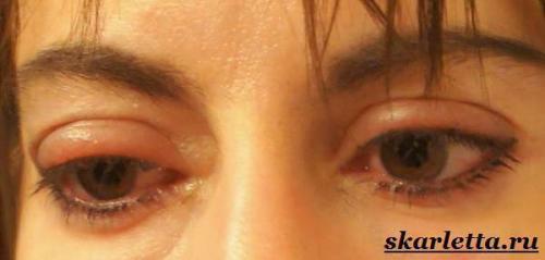 Как убрать отек с глаз после слез утром. Как убрать опухшие глаза после слез на утро опухли глаза. Отеки глаз после слез. Почему появляются и как избавиться