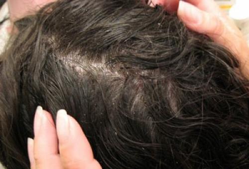 Мазь от зуда кожи головы. Всегда ли перхоть и зуд сопутствуют друг другу?