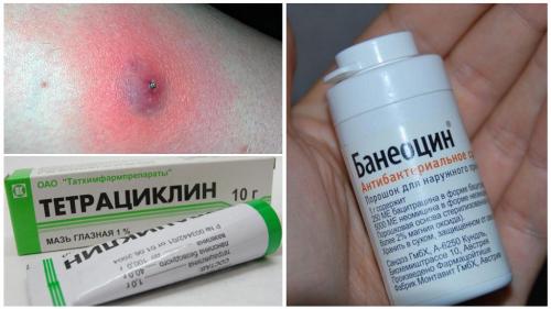 Средства от зуда после укуса насекомых. Что делать при наличии гнойников