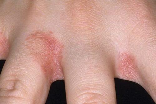 Шелушение кожи на подушечках пальцев рук причины. Заболевания.