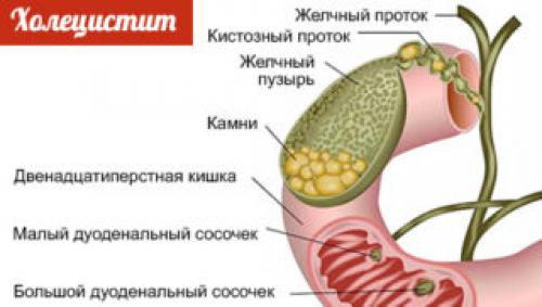 Камни в желчных протоках. Профилактика острого холецистита памятка. Хронический холецистит памятка. Острый холецистит памятка. Острый хронический холецистит памятка.