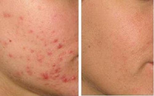 Экстракт алоэ вера для кожи. Какая польза алоэ в ампулах для лица 06 Экстракт алоэ вера для кожи. Какая польза алоэ в ампулах для лица 06