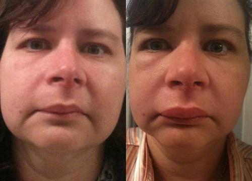 Отекшее лицо причины у женщин. Отек и неправильный образ жизни 03