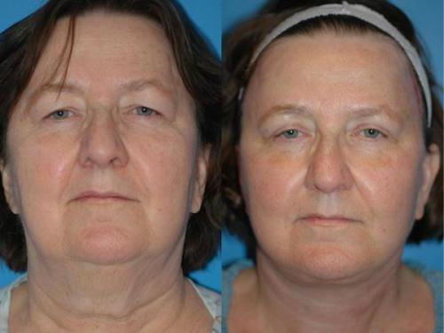 Косметические процедуры для лица после 60 лет. Омоложение лица после 60 лет