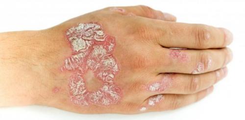 Облазит кожа на пальцах рук и ног у взрослого. Причины