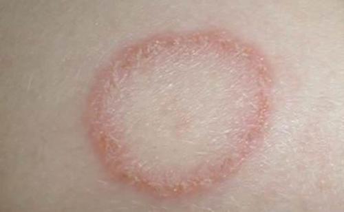 Мицелий гриба на коже, что это. Классификация по типу возбудителя