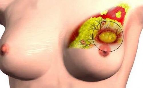 Овальное уплотнение в молочной железе. Разновидность опухолей