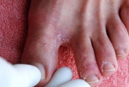 Облазит кожа между пальцами ног. Лечение кожи стоп