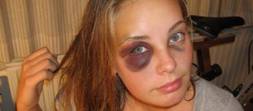 Как снять опухоль с глаза после удара в домашних условиях. Методы быстрого избавления гематомы глаза после удара: лечение медикаментами и народными средствами