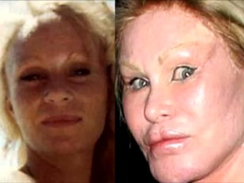 Ботокс последствия. Какие причины могут вызывать появление побочных эффектов