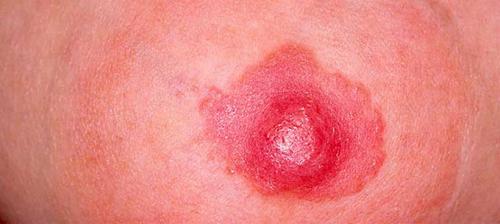 Припухлость на ореоле соска. Причины нетипичного покраснения сосков