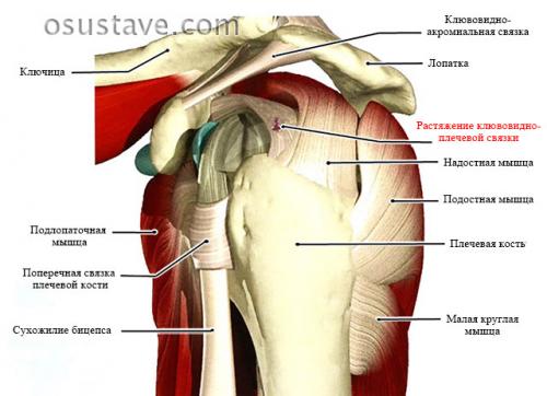 Как замотать плечо при растяжении. Причины растяжения связок плечевого сустава, симптомы, как лечить