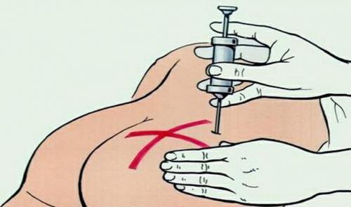 Колим Уколы. Как правильно делать уколы в ягодицу