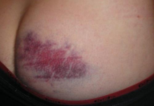 Колим Уколы. Как правильно делать уколы в ягодицу