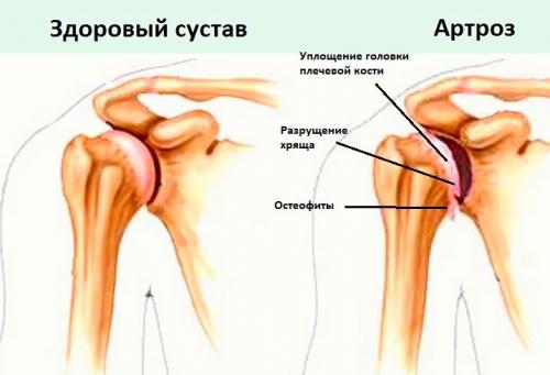Боль и хруст в плече. Почему болит и хрустит плечо?