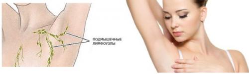 Лимфоузлы под мышкой. Основные причины воспаления лимфатического узла в подмышечной области