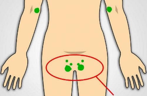 Ноющая боль в лимфоузлах. Симптомы болезни - боли в лимфоузлах 03 Ноющая боль в лимфоузлах. Симптомы болезни - боли в лимфоузлах 03