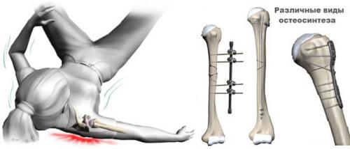 Остеосинтез плечевой кости реабилитация. Остеосинтез кости плеча