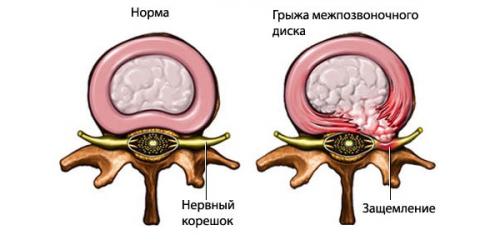 Хруст суставов, как лечить. Существует ли повод для беспокойства 04 Хруст суставов, как лечить. Существует ли повод для беспокойства 04